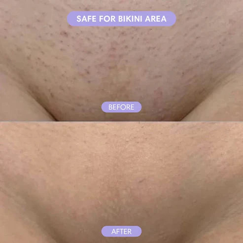 Bikini Pain-Free Hair Removal Cream-Bundle (Spray + Cream)