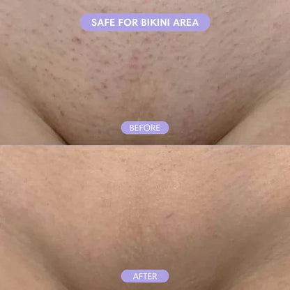 Bikini Pain-Free Hair Removal Cream-Bundle (Spray + Cream)